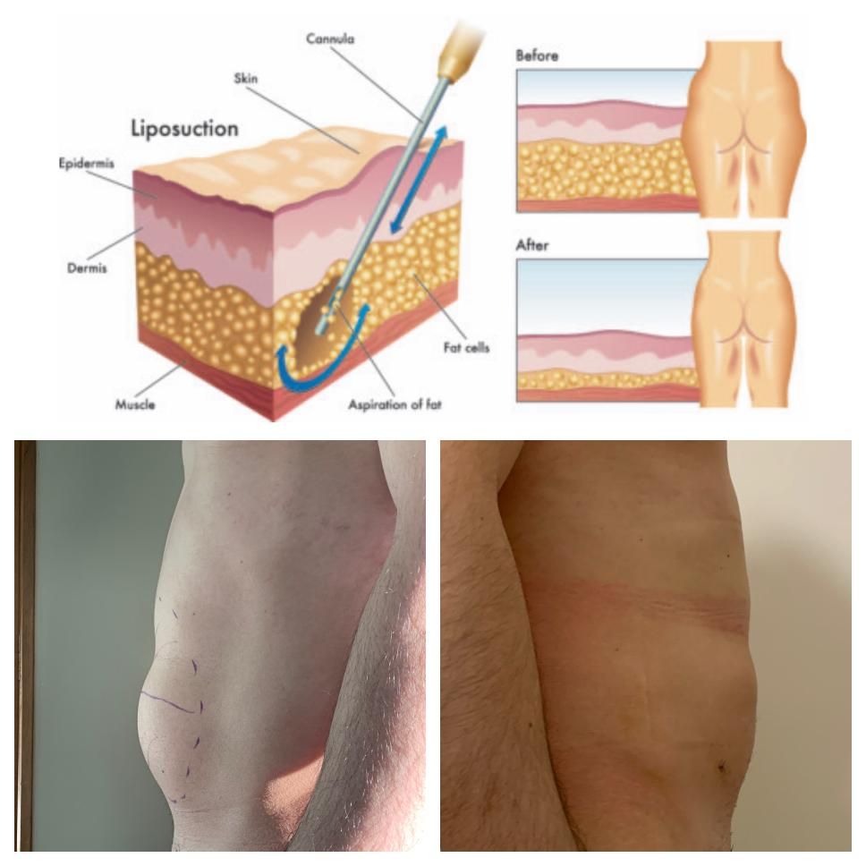 LIPOSCULTURA